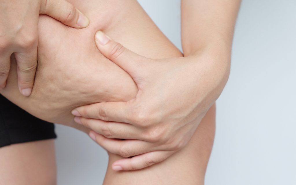 Cellulite
