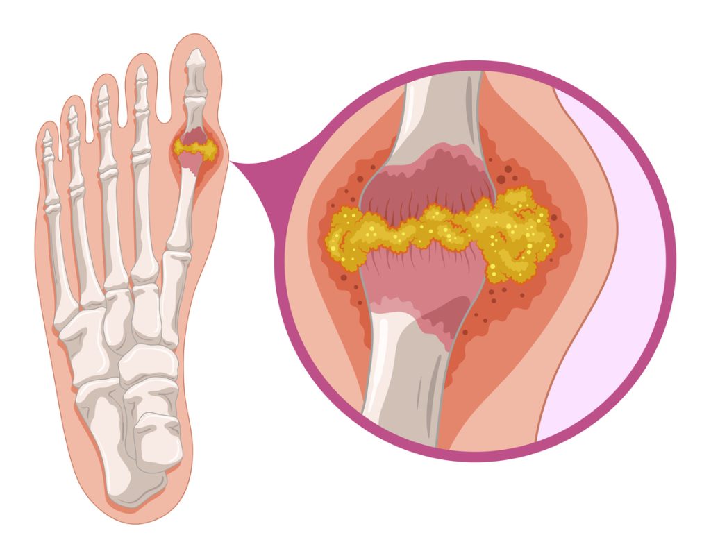 Acide urique gros orteil